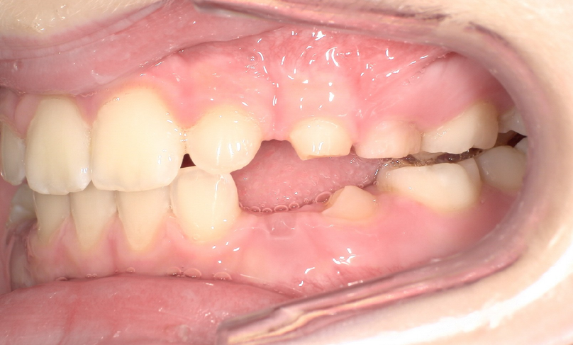 After treatment