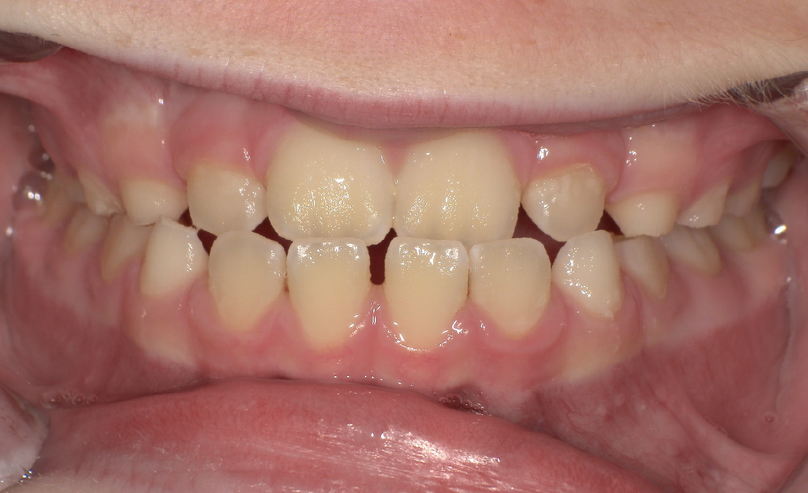 Before treatment
