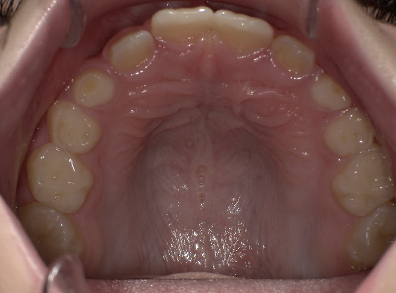Before treatment
