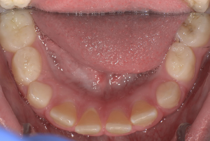 Before treatment