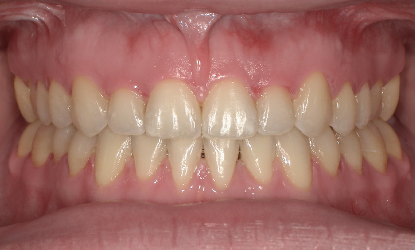 After treatment