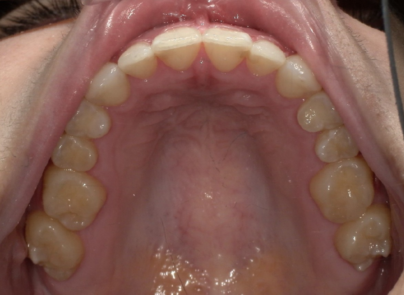After treatment
