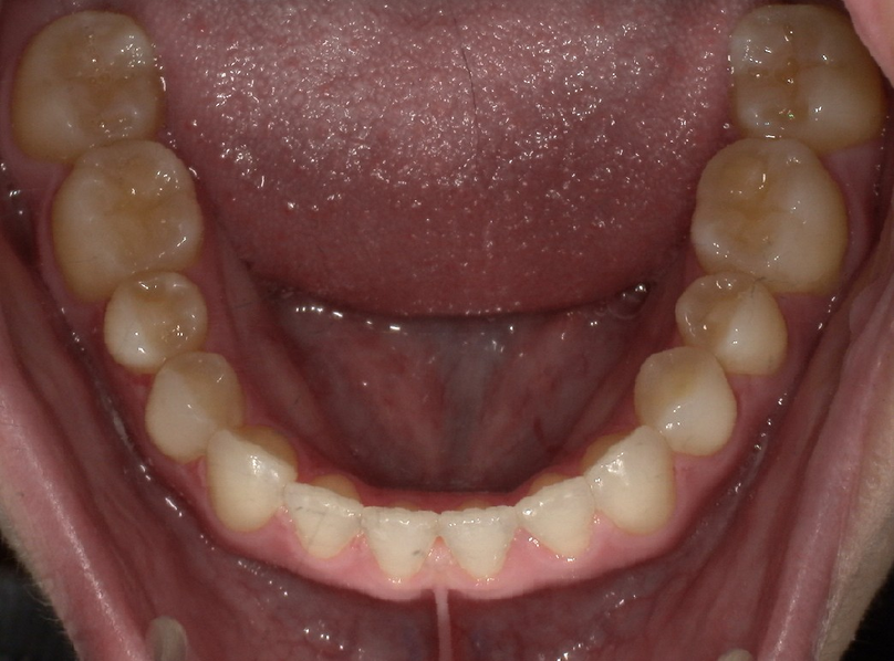After treatment