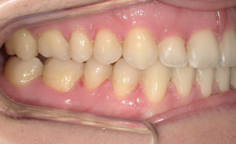After treatment
