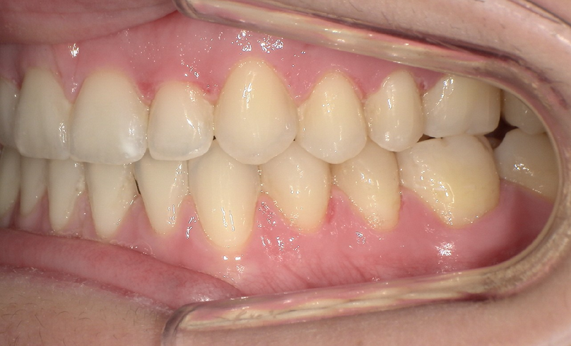 After treatment