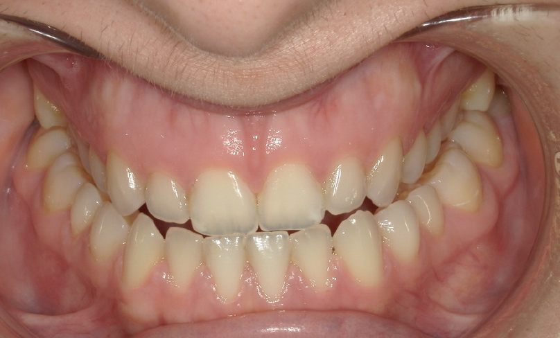 Before treatment