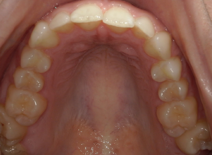 Before treatment