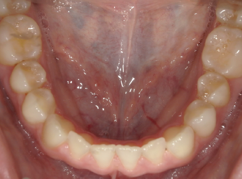 Before treatment