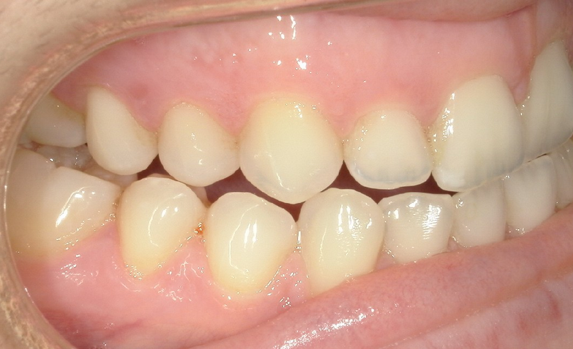 Before treatment
