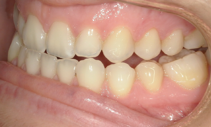Before treatment