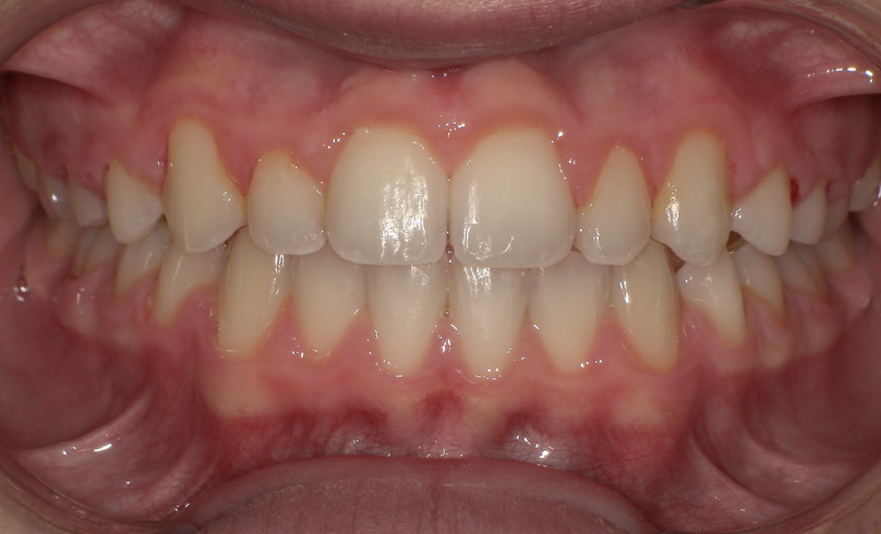 After treatment