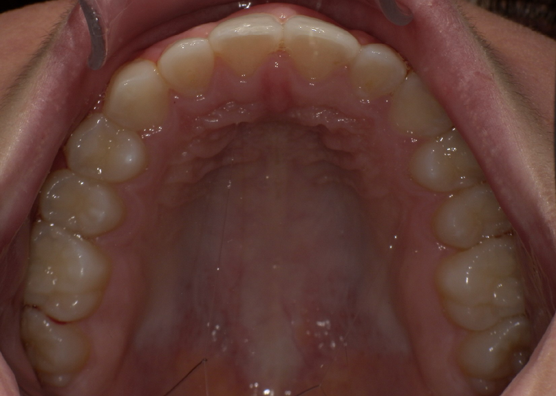 After treatment