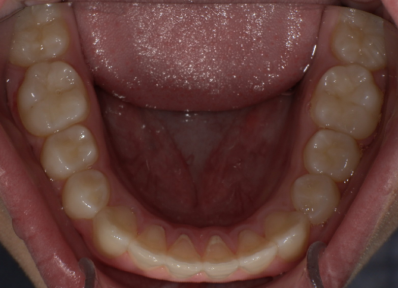 After treatment