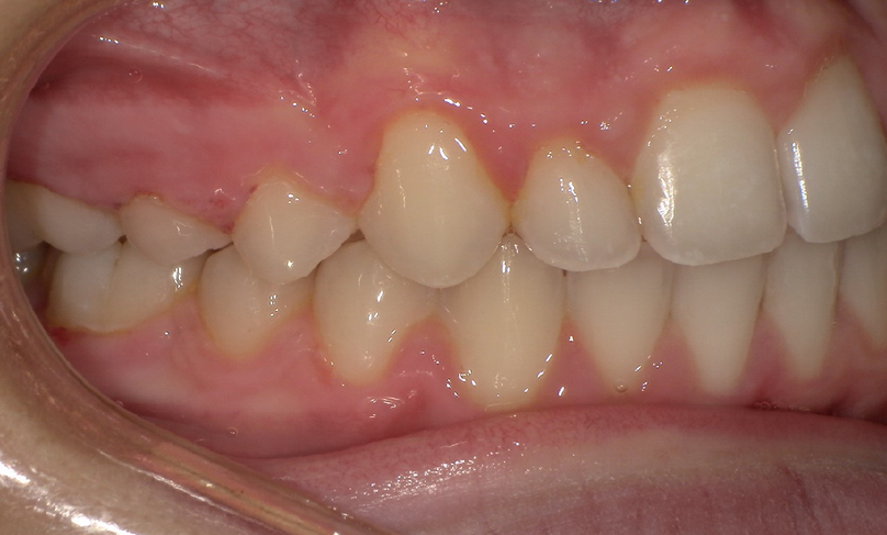After treatment