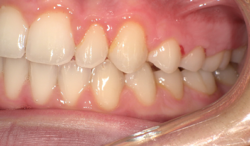 After treatment