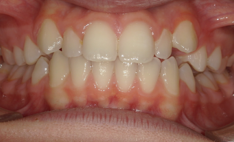 Before treatment