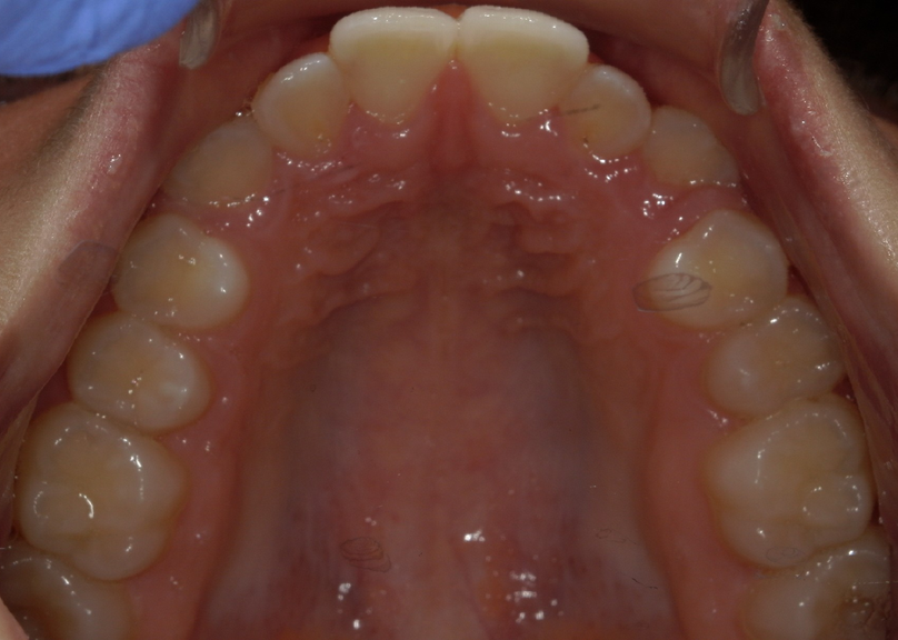 Before treatment