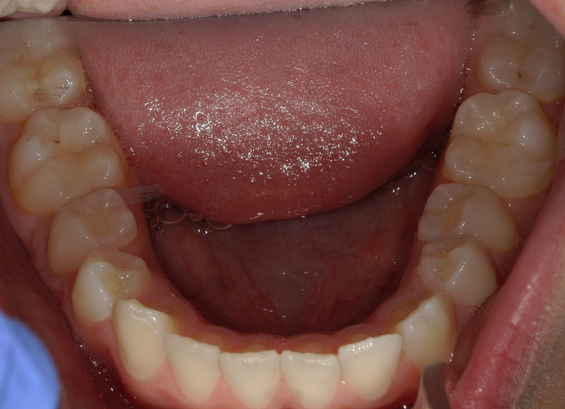 Before treatment