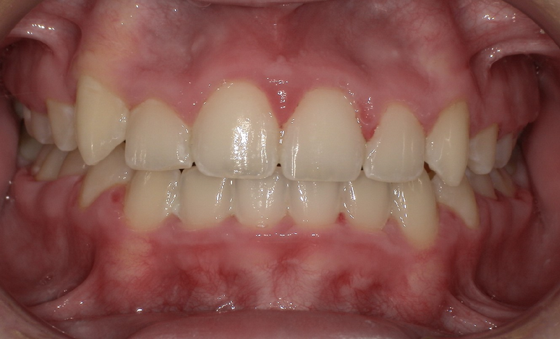 After treatment