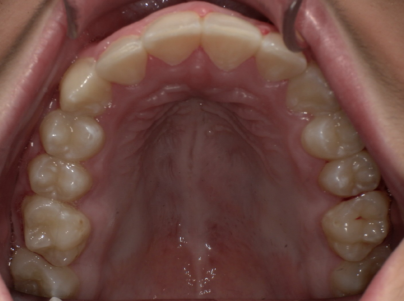 After treatment
