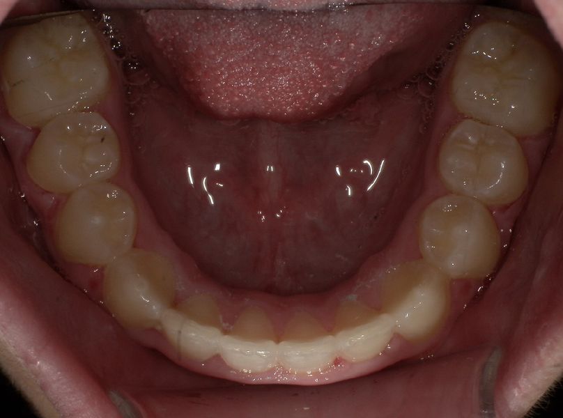 After treatment