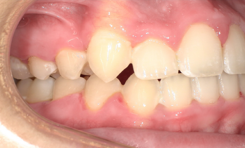 After treatment