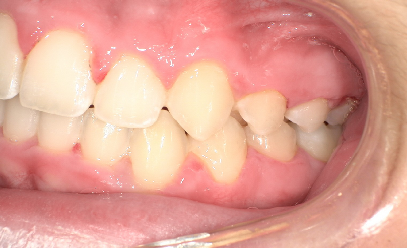 After treatment