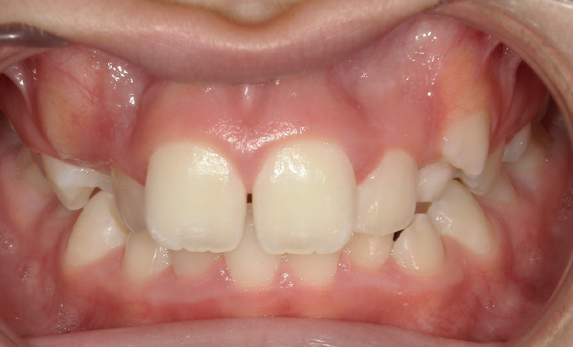 Before treatment