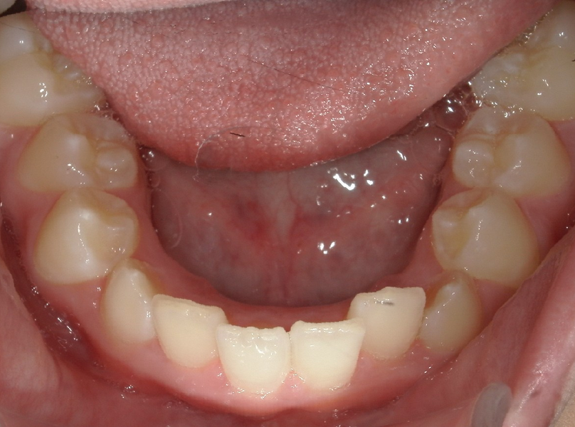 Before treatment