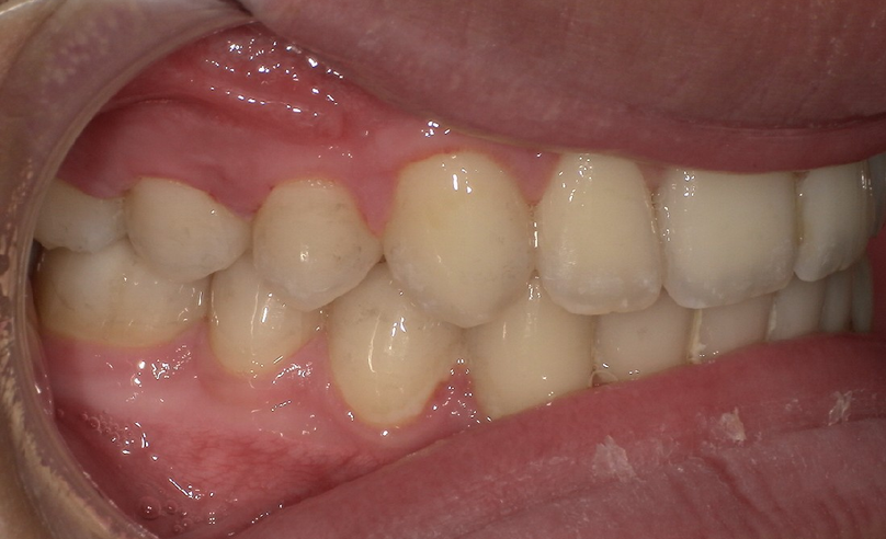 After treatment