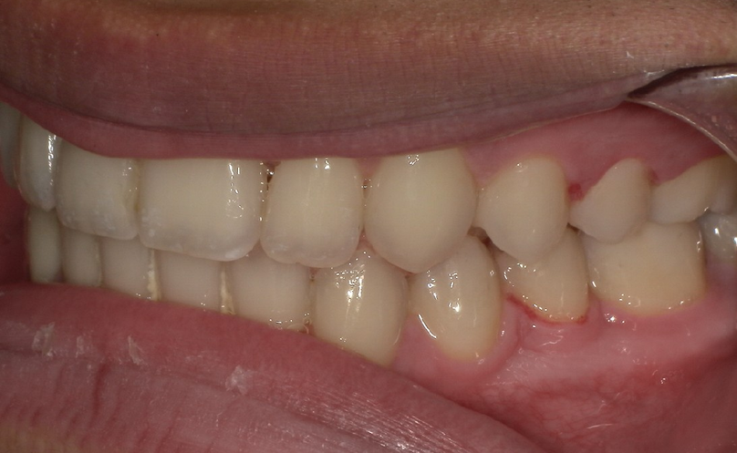After treatment