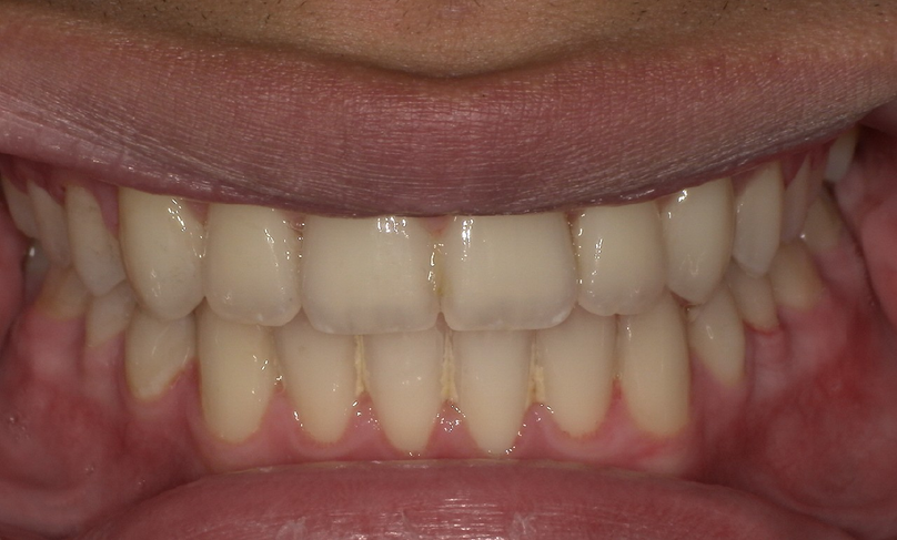 After treatment