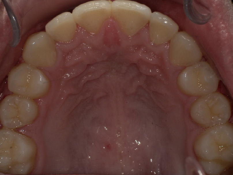 After treatment