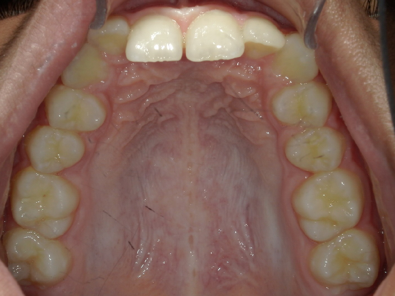 Before treatment