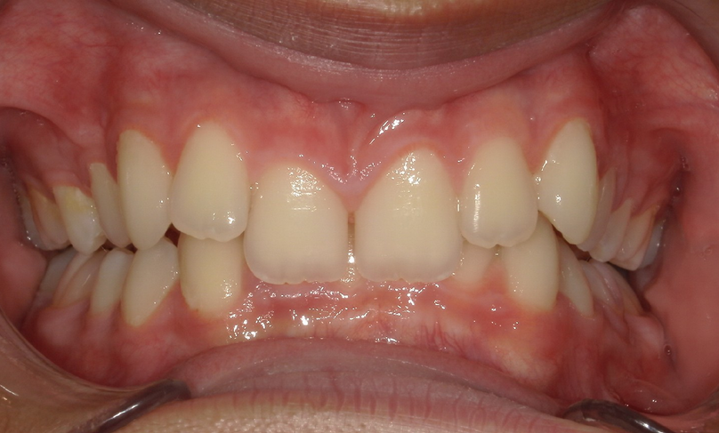 Before treatment