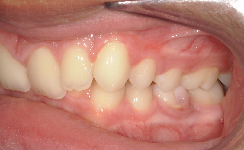 Before treatment