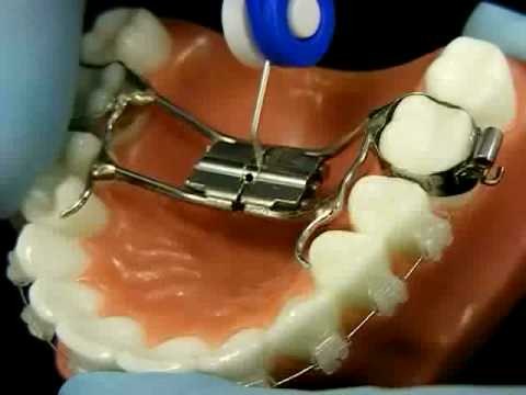 Palatal Expander