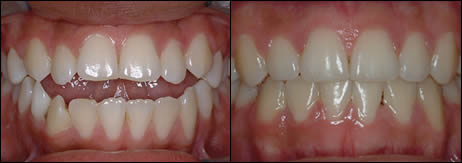 Patient 54 before and after orthodontic Openbite treatment