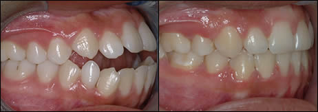 Patient 53 before and after orthodontic Openbite treatment