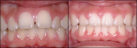 Patient 69 before and after orthodontic Buckteeth treatment