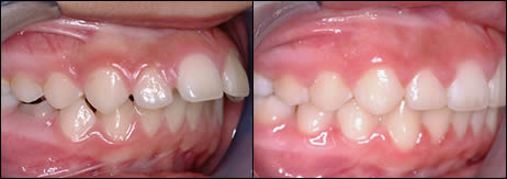 Patient 68 before and after orthodontic Buckteeth treatment