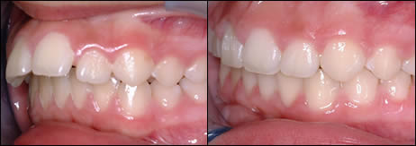 Patient 52 before and after orthodontic Overbite treatment