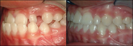 Patient 55 before and after orthodontic Crossbite treatment