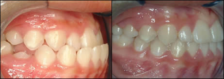 Patient 56 before and after orthodontic Crossbite treatment