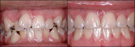 Patient 60 before and after orthodontic Crowding treatment