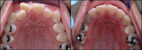 Patient 1 before and after orthodontic treatment