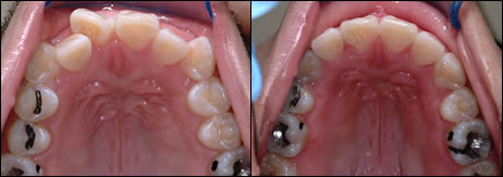 Patient 59 before and after orthodontic Crowding treatment