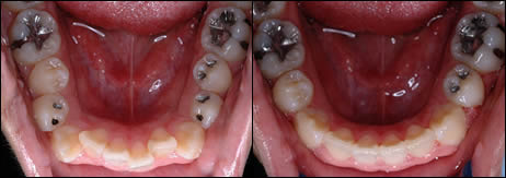 Patient 58 before and after orthodontic Crowding treatment