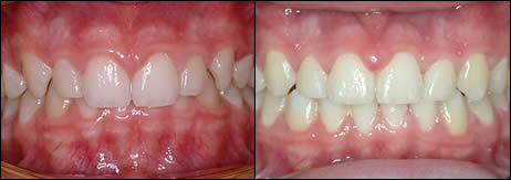 Patient 63 before and after orthodontic Deepbite treatment