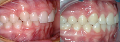 Patient 62 before and after orthodontic Deepbite treatment